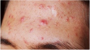 istockphoto_rf_photo_of_teen_boy_acne