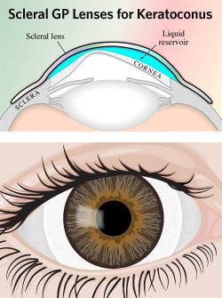 scleral-lens-250x335